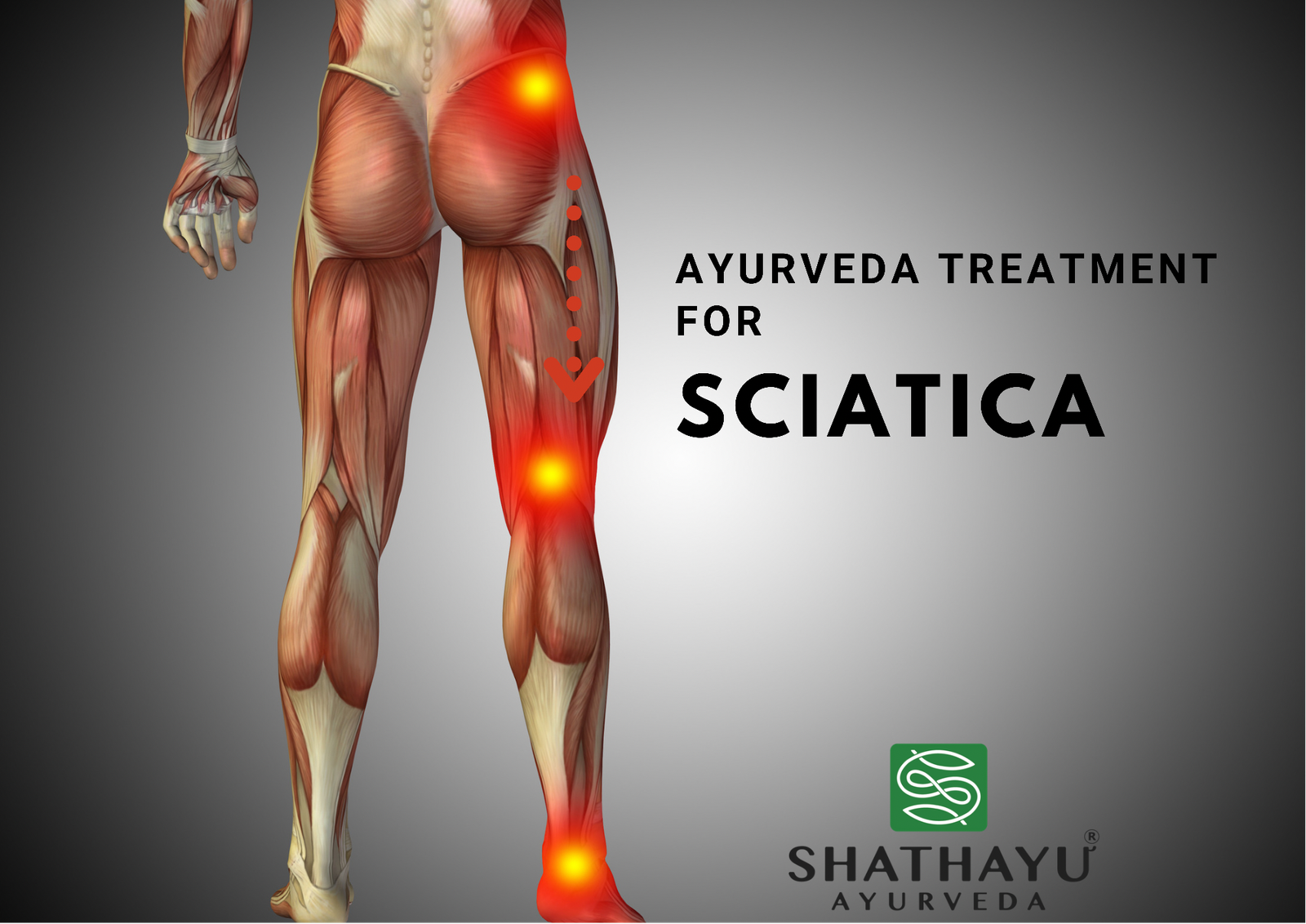 5 Best Home Remedies To Ease Sciatica Pain
