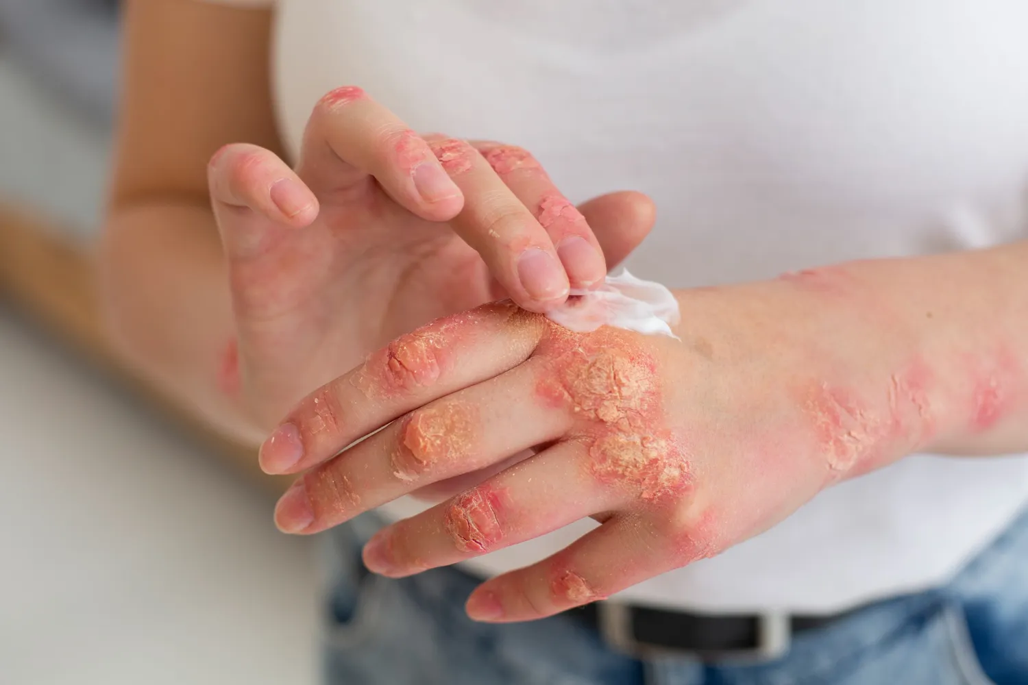skin disorder