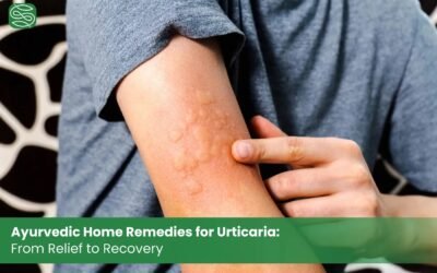 Ayurvedic Home Remedies for Urticaria: From Relief to Recovery