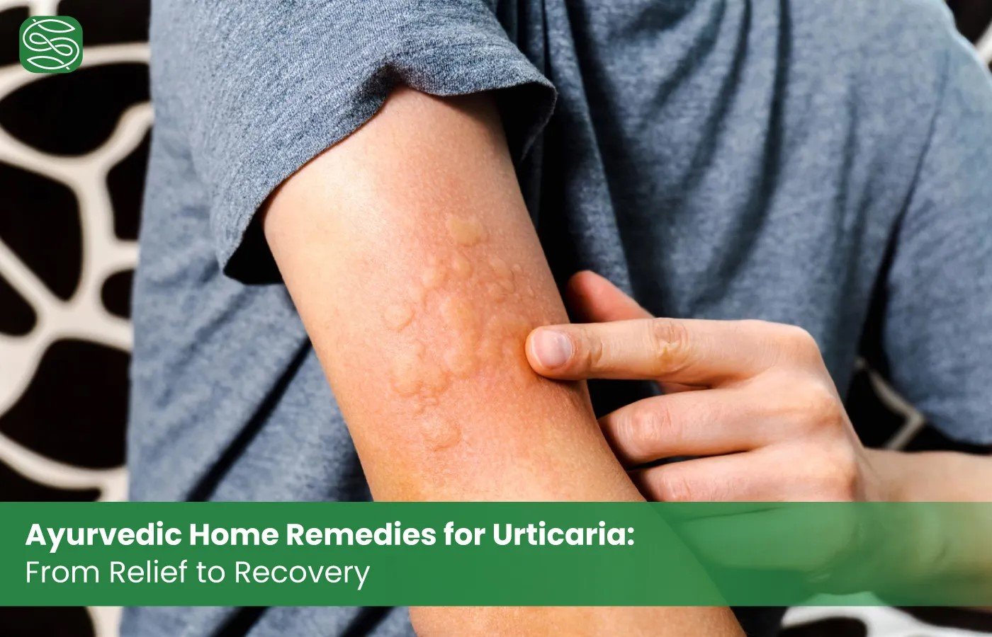 Ayurvedic Home Remedies for Urticaria: From Relief to Recovery