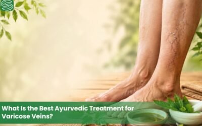 What Is the Best Ayurvedic Treatment for Varicose Veins