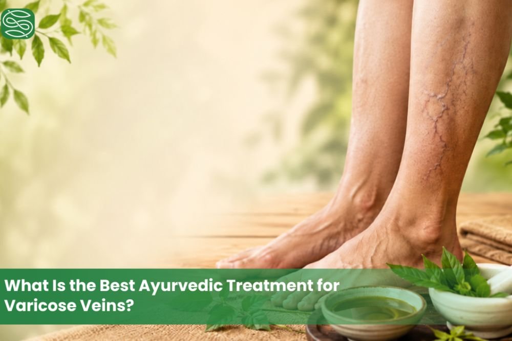 What Is the Best Ayurvedic Treatment for Varicose Veins